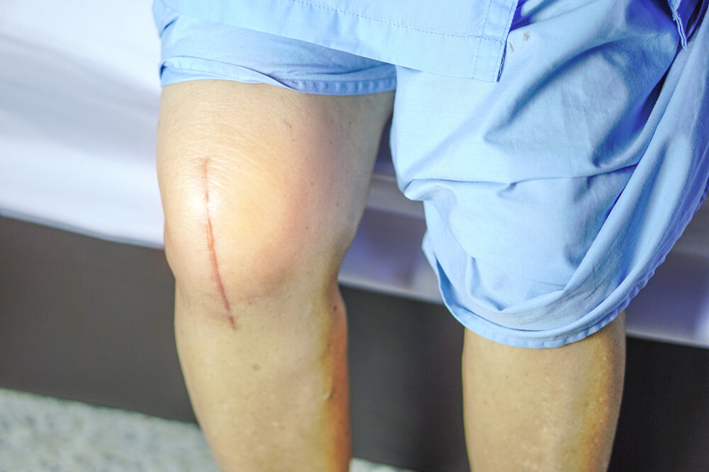 Реабилитация после эндопротезирования коленного сустава в домашних условиях