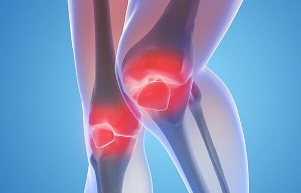 Артроз коленного сустава — Лечение и профилактика заболеваний позвоночника и суставов.