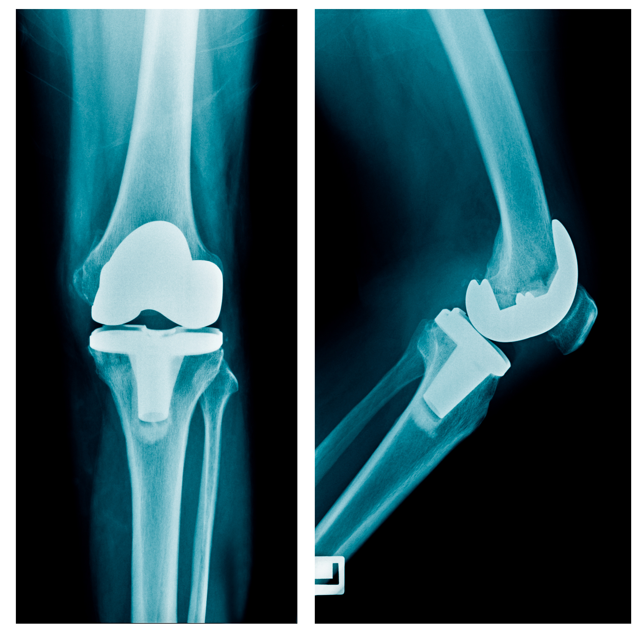 Эндопротезирование коленного сустава клиника. Рентген эндопротеза коленного сустава. Рентген эндопротеза тазобедренного сустава. Артропластика коленного сустава. Эндопротезирование коленного Stryker.